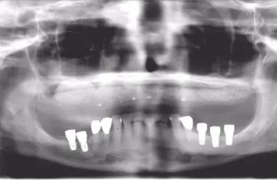 X-Ray of a patient's mouth for a sinus bone regeneration procedure with dental implants from Implant & Periodontics Solutions in  Sun City West, AZ