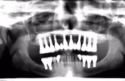 X-Ray of a patient's mouth for a sinus bone regeneration procedure with dental implants from Implant & Periodontics Solutions in Sun City West, AZ