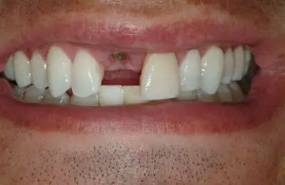 Patient before a soft tissue procedure from Implant & Periodontics Solutions in Sun City West, AZ