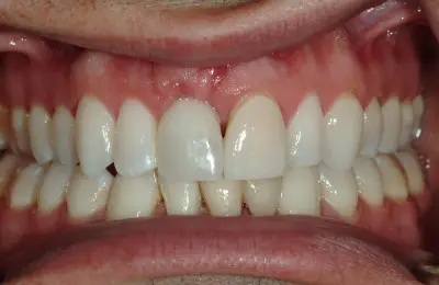 Patient smiling after a soft tissue procedure from Implant & Periodontics Solutions in Sun City West, AZ