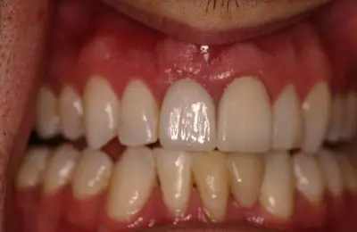 Patient with discolored teeth before a soft tissue procedure from Implant & Periodontics Solutions in Sun City West, AZ