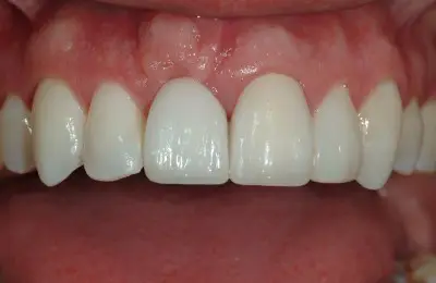 Patient smiling with healthy teeth after a soft tissue procedure from Implant & Periodontics Solutions in Sun City West, AZ