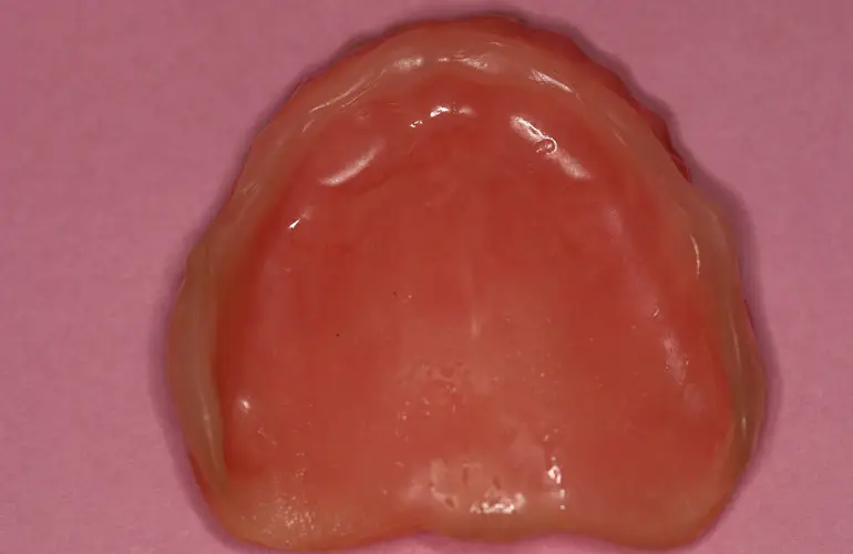 Mold for Teeth-In-A-Day from Implant & Periodontics Solutions in Sun City West, AZ