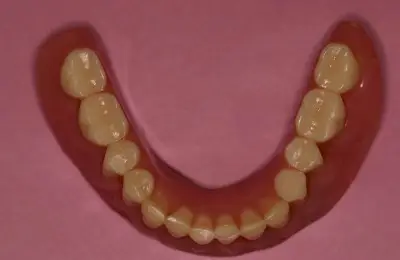 Mold with teeth for Teeth-In-A-Day from Implant & Periodontics Solutions in Sun City West, AZ