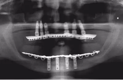 X-Ray for Teeth-In-A-Day in Implant & Periodontics Solutions in Sun City West, AZ