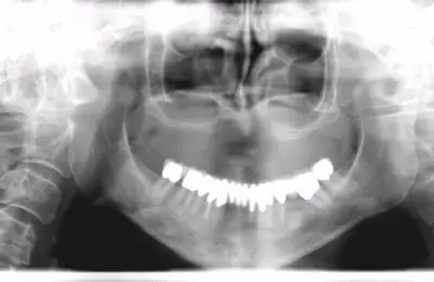 X-Ray for an Upper Jaw Case Study with dental implants from Implant & Periodontics Solutions in Sun City West, AZ