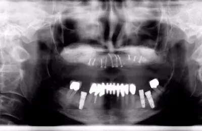 X-Ray for an Upper Jaw Case Study with dental implants  from Implant & Periodontics Solutions in Sun City West, AZ