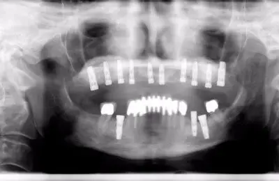 X-Ray for an Upper Jaw Case Study with dental implants  from Implant & Periodontics Solutions in Sun City West, AZ