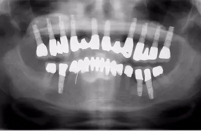 X-Ray for an Upper Jaw Case Study with dental implants  from Implant & Periodontics Solutions in Sun City West, AZ