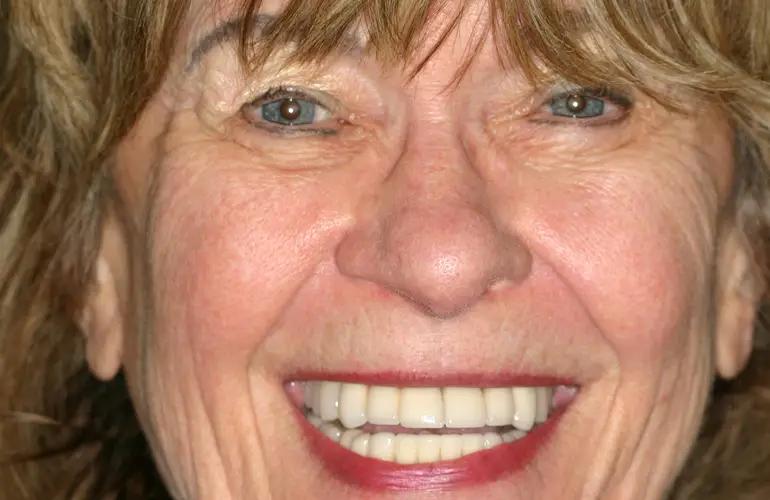 Smiling patient for an Upper Jaw Case Study with dental implants  from Implant & Periodontics Solutions in Sun City West, AZ