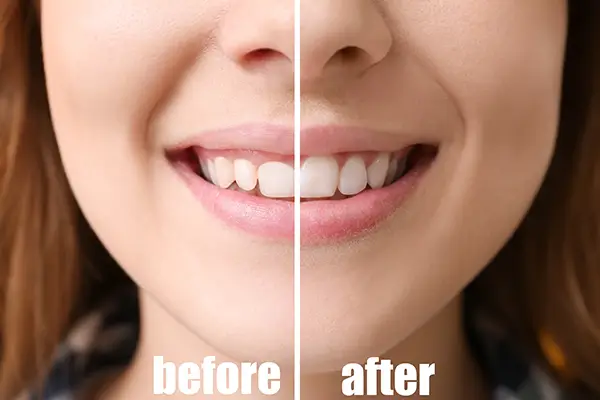 Before and after comparison of a woman's smile showing improved gum contour after gingival contouring.