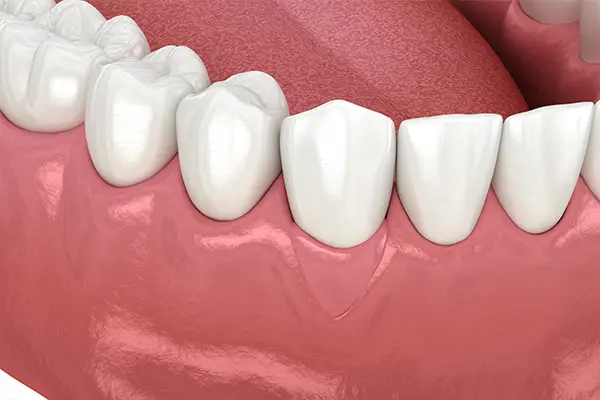 Gums fully restored after a successful gum grafting procedure, showcasing healthy tissue.