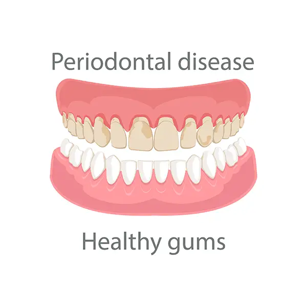 Illustration of healthy gums compared to gums affected by periodontal disease, emphasizing the visible differences in oral health.