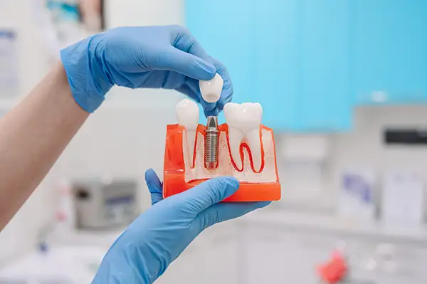 Close-up of a dentist's gloved hand holding a dental implant demonstration model with a crown.